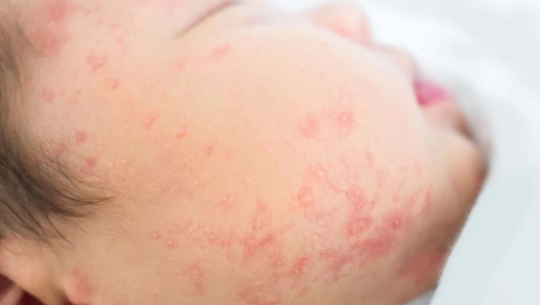 Cara Mengatasi Alergi pada Bayi