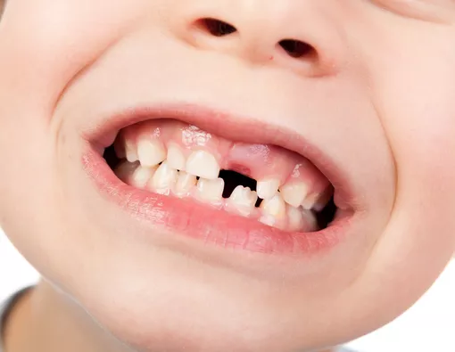 Cara agar Gigi Anak cepat Tanggal