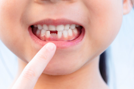 Cara agar Gigi Anak cepat Tanggal
